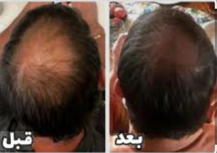 سرم ضد ریزش مو اورجینال